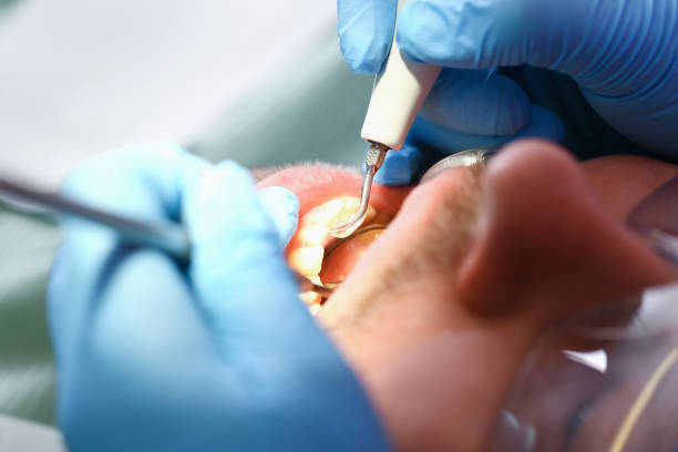 Best Emergency Dental Care for Abscessed Tooth in Conshohocken, PA